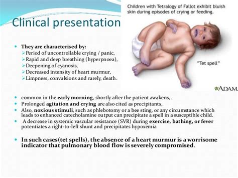 Tetralogy of fallot spells