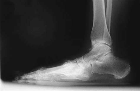 Midfoot Arthritis - Footcare Friday: Alpine Orthopedics and Sports Medicine: Orthopedic Surgery