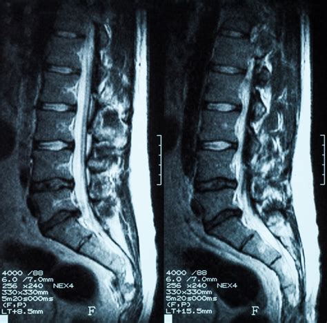 Lower back pain - Is your X-ray or MRI doing more harm than good? - Evercore - Move With a ...