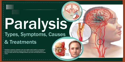 Paralysis - campestre.al.gov.br