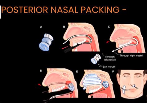 EPISTAXIS: Causes and Management - NEET PG ENT