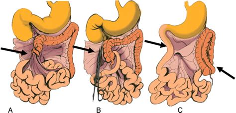 Assessment of recurrent abdominal symptoms after Ladd procedure: clinical and radiographic ...