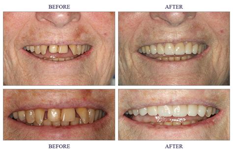 Porcelain Crowns Before And After - Dental News Network