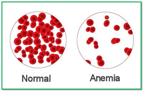 Ayurvedic Treatment for Anemia | Natural Treatment | Herbal Remedies ...