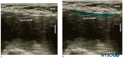 Ultrasound-Guided Fascia Iliaca Block - NYSORA