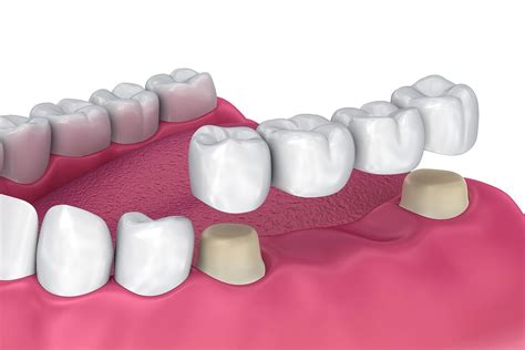 Crowns & Bridges | Sarum Dental Practice | Salisbury Dentist