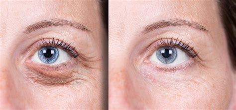 Laser Resurfacing Under the Eyes