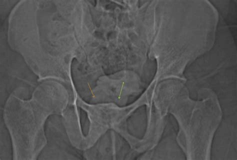 Symphysis Pubis Fusion - Sumer's Radiology Blog