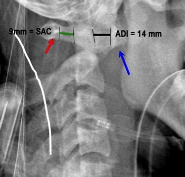 Atlantoaxial Instability - Spine - Orthobullets