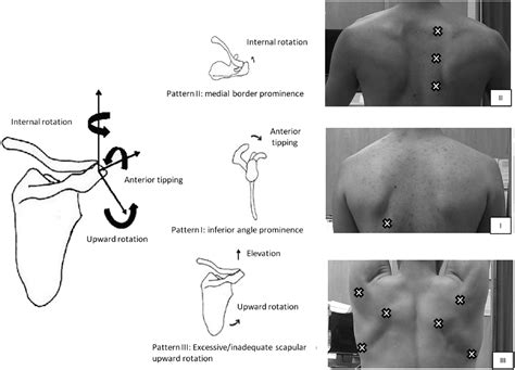 Icd 10 Scapular Dyskinesis: Understanding The Causes And Symptoms – MartLabPro