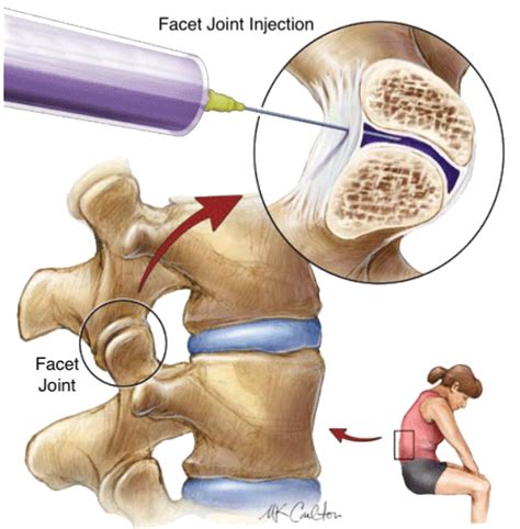 Short Term Treatments for Back Pain - Back Pain Treatment