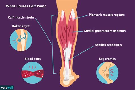 7 Common Causes of Calf Pain and How to Treat Them