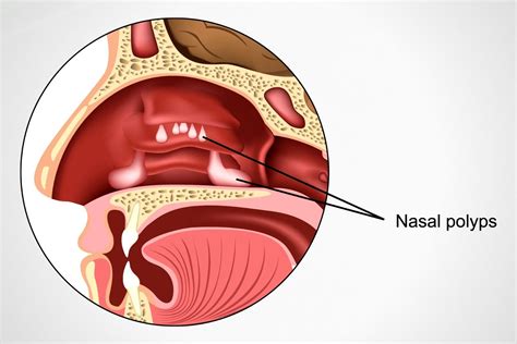 Nasal Polyps