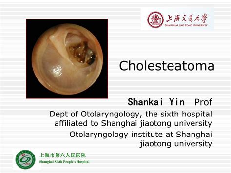 PPT - Cholesteatoma PowerPoint Presentation, free download - ID:2957605