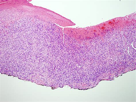 Benign Fibrous Histiocytoma | Dermatopathology