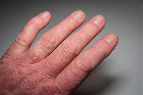 Clinical Features of Psoriatic Arthritis Rheumatische Arthritis, Psoriatic Arthritis Symptoms ...