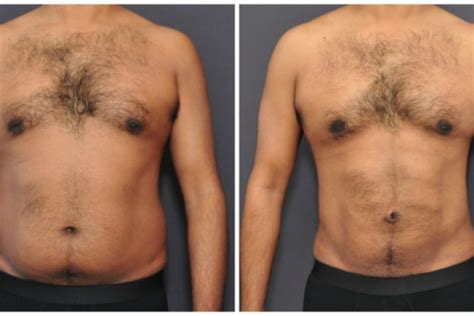 Liposuction for Men San Francisco | David Sieber, M.D.