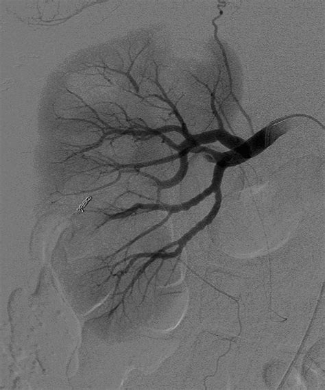 Selective right renal artery angiogram after embolisation demonstrates... | Download Scientific ...