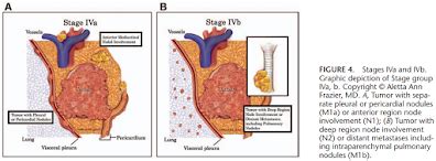 Radiotherapy Dictionary: Thymoma and thymic carcinoma staging systems