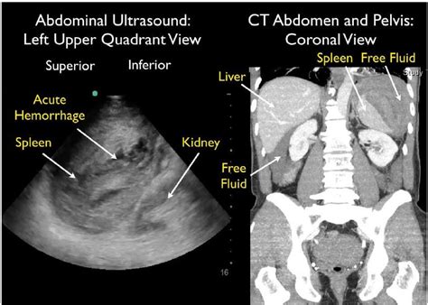 Splenic Rupture Diagnosed with Bedside Ultrasound in a Patient with Shock in the Emergency ...