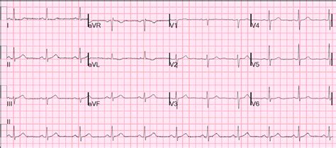 Dr. Smith's ECG Blog: A Case of Clinical Unstable Angina in the ED