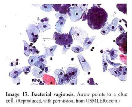 Important Facts About Gardnerella Vaginalis (not An STI), 60% OFF