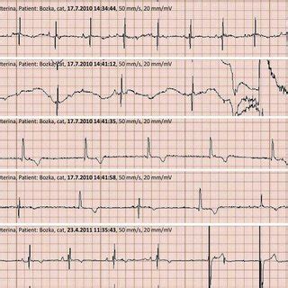 Figure1. Resting ECG immediately before carotid sinus massage, sternal... | Download Scientific ...