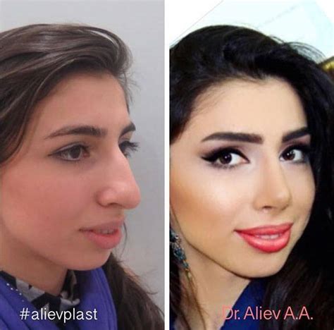 Big Nose Plastic Surgery Before And After » Rhinoplasty: Cost, Pics, Reviews, Q&A