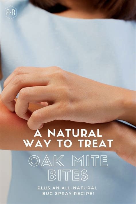 How to Treat Oak Mite Bites • Bee and Basil in 2020 | Oak mites, Oak mite bites, Natural bug spray