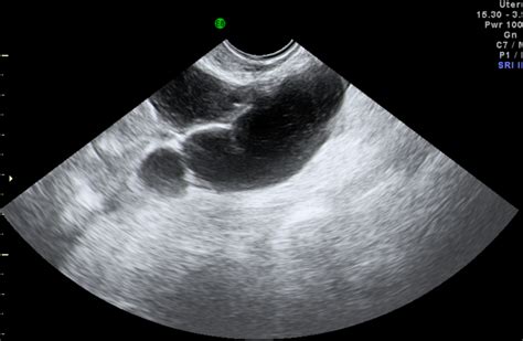 Chapter 8 – Tubal block and hydrosalpinx – Melaka Fertility