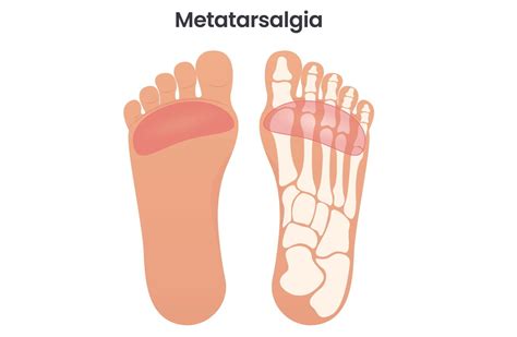 Metatarsalgia Surgery in Miami: Expert Treatment for Foot Pain