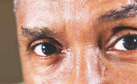 Have You Heard About an Eye Stroke? | Eye stroke, Stroke symptoms, Eyes