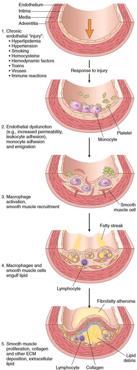 9. Pathomorphology, pathogenesis and complications of atherosclerosis ...