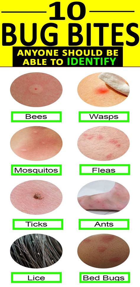 A Good Remedy For Bed Bug Bites | Health Info - Bed Bugs