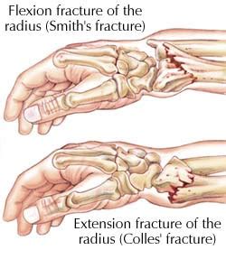 akumahubelajar: Common fractures of the forearm