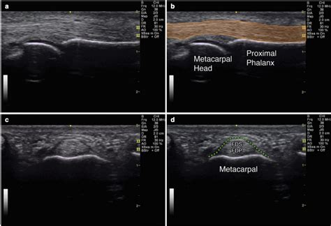 Diagnostic Wrist and Hand Ultrasound - Sports Medicine Review