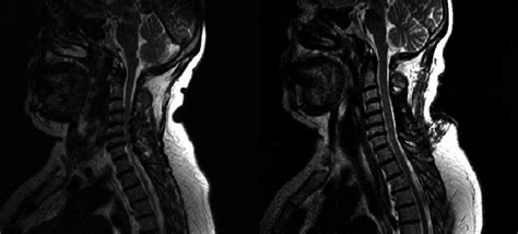 The MR images of Hemilaminectomy performed patient. Preoperative (left ...