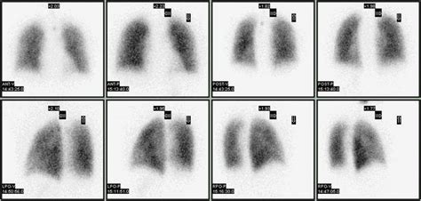 Lung ventilation/perfusion scan | medicine | Britannica