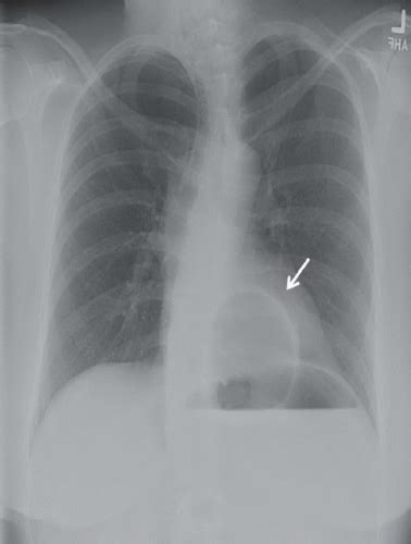 Gastric Volvulus | Radiology Key