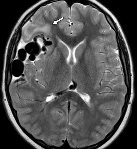 Arteriovenous Malformation Mri