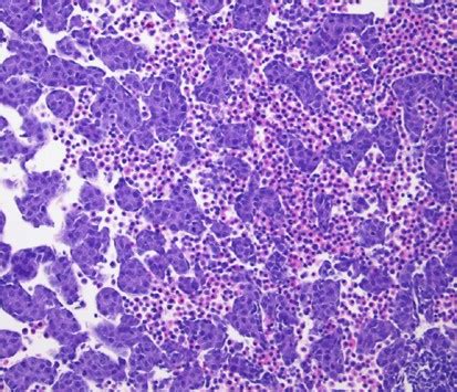 Benign extramedullary myeloid proliferations | Modern Pathology