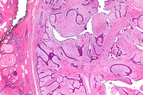 Phyllodes Tumor of Breast