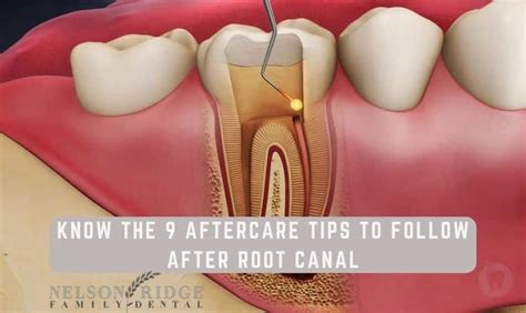 What Should Be Done After Undergoing Root Canal Treatment?