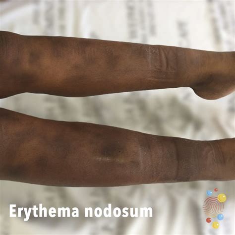 Erythema nodosum - Skin Deep