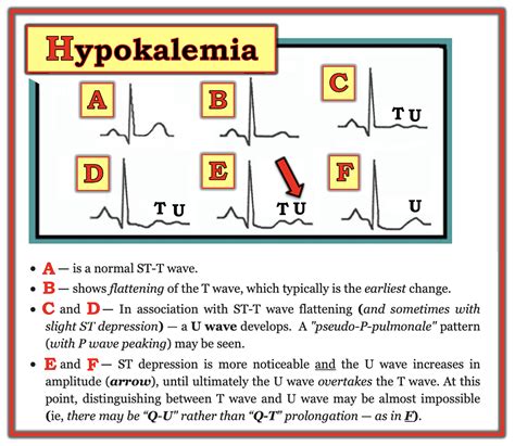 Ecg Ekg Changes In Hypokalemia And Hyperkalemia Ecg Should Be Done On | The Best Porn Website