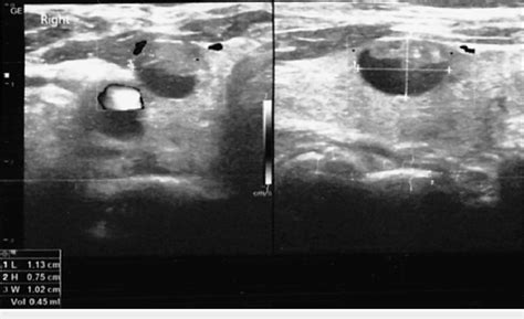 Neck ultrasound showing the thyroid nodule with cystic features and... | Download Scientific Diagram