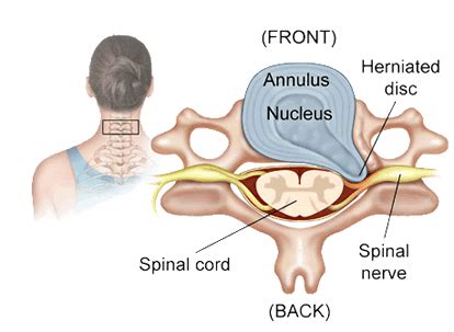 Herniated Cervical Disc