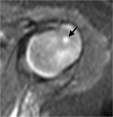 A greater tuberosity pre-ossification center in a 4-month-old girl.... | Download Scientific Diagram