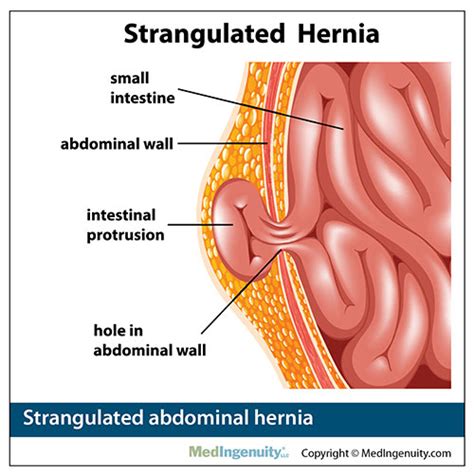 Treatments for Hernia and Hernia Surgery in Alaska | Alaska Hernia Center