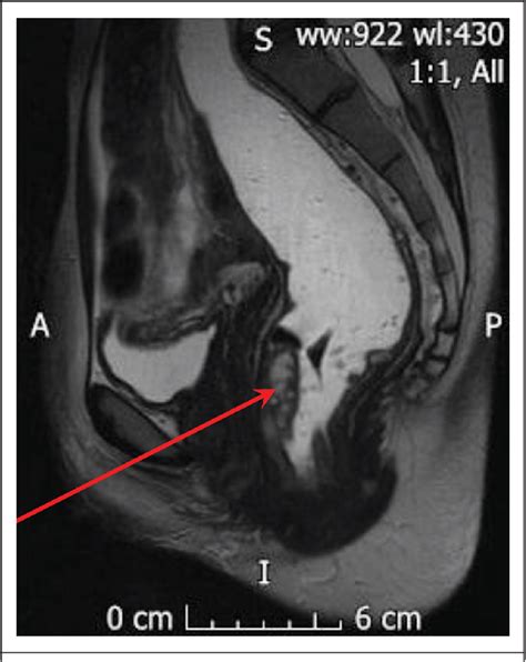 Figure 1 from Ultra-low anterior resection with coloanal anastomosis for recurrent rectal ...